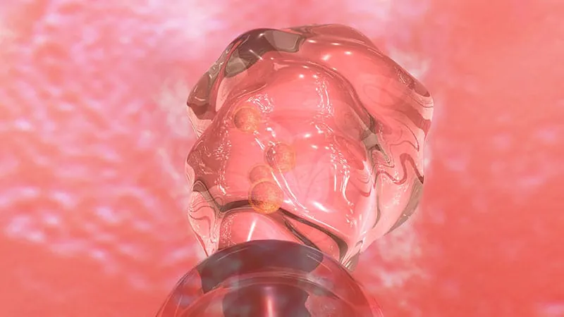 Skip the surgery? Endometriosis may not need treatment before IVF embryo transfer