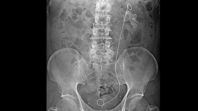 Longer ureteral stent dwell time raises UTI risk in kids, even with antibiotics