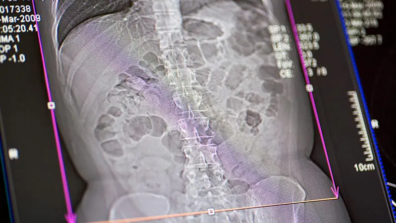 Routine CT scans could double as bone density screeners, study finds