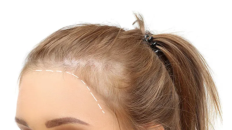 Oral minoxidil beats topical in slowing female pattern hair loss progression