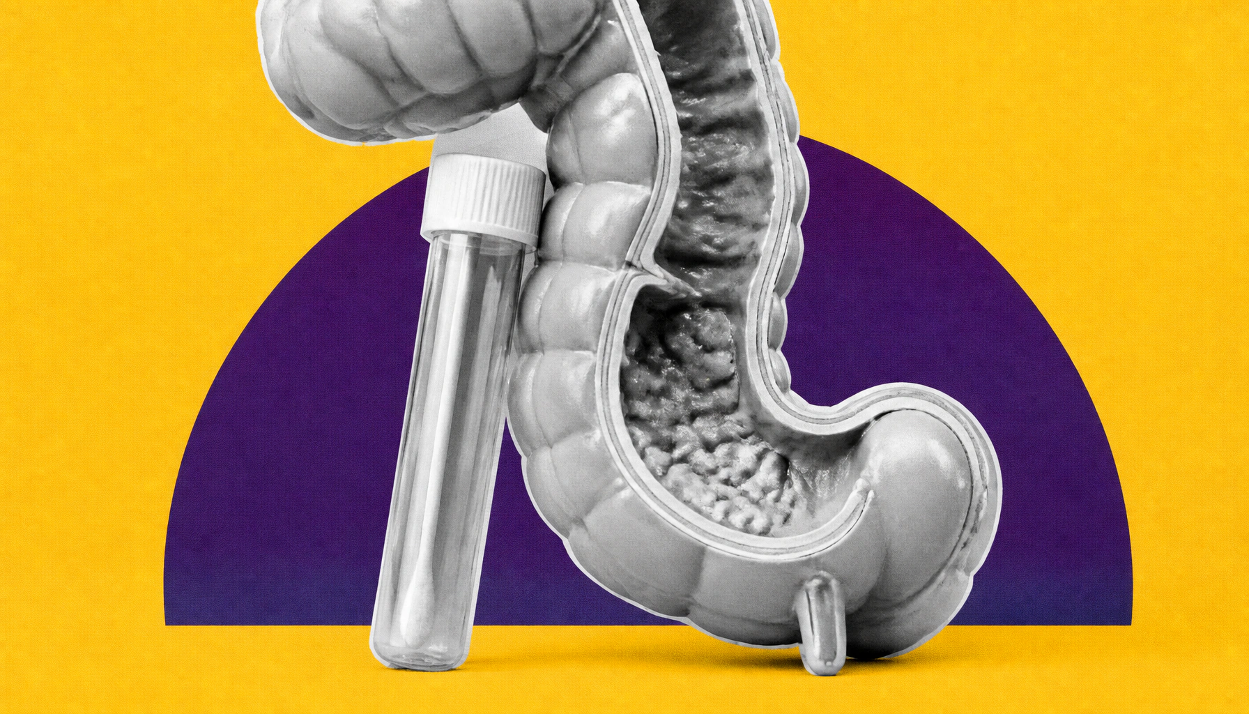 Genetic marker flags IBD patients at risk for severe disease