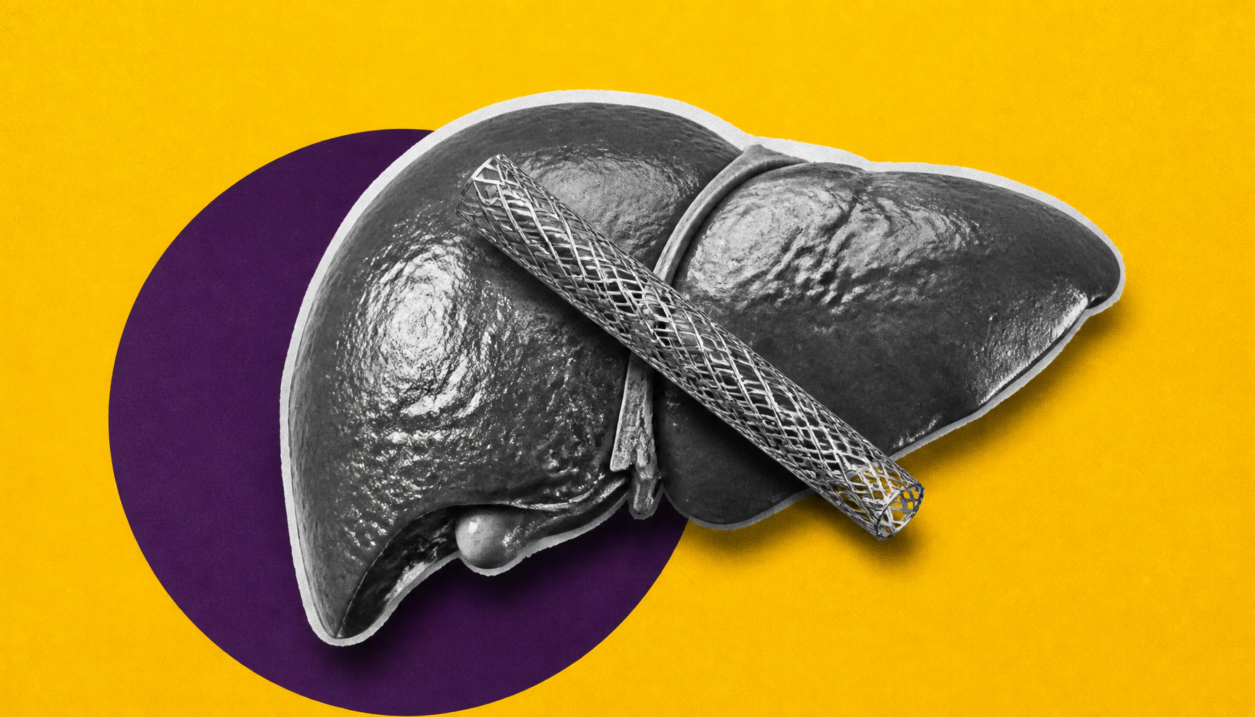 Fatty liver linked to more complex heart disease in heart attack patients