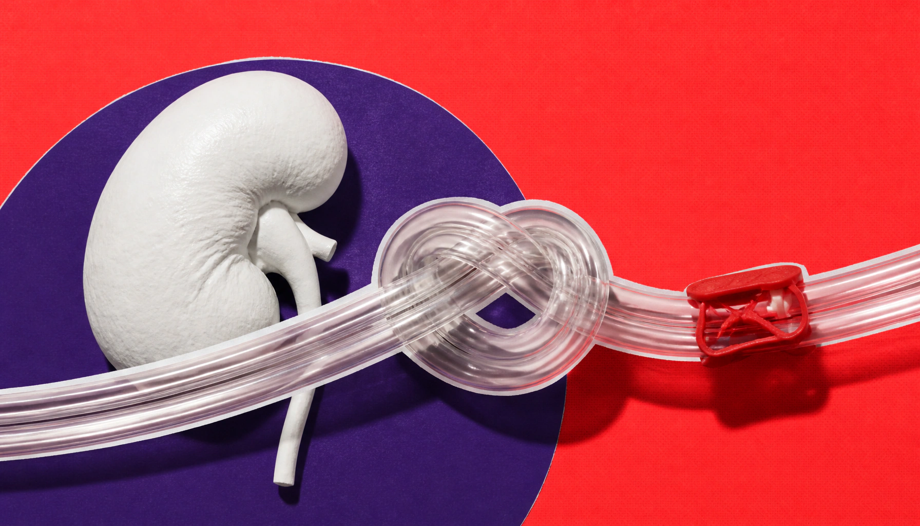 How you start dialysis may determine whether you ever get a kidney transplant