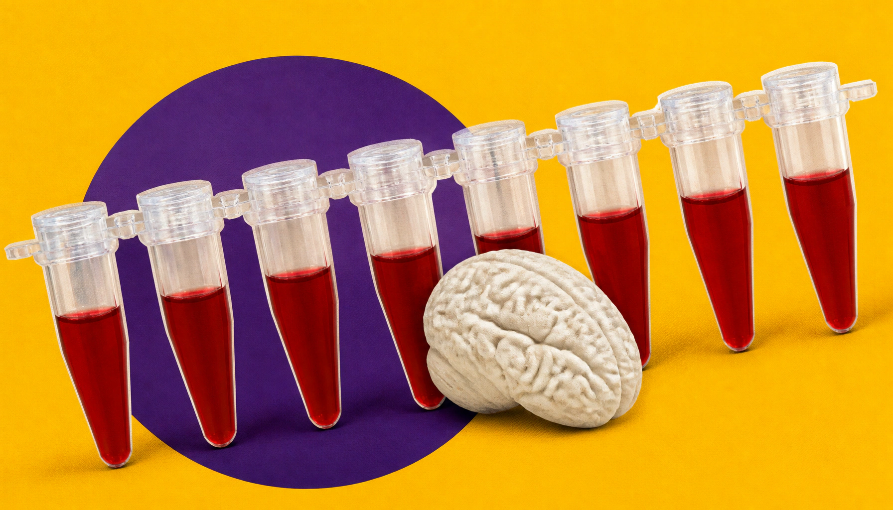 A simple blood test for Alzheimer's? RNA biomarkers could make it possible