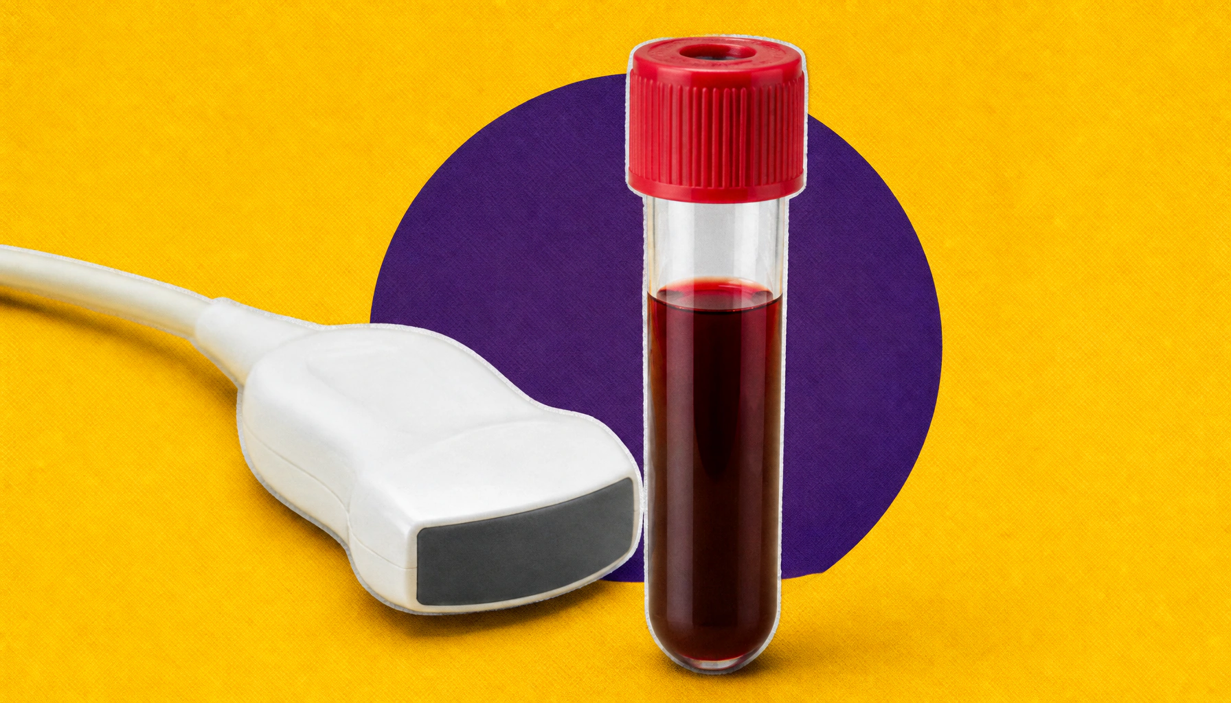 New blood test catches endometriosis cases that imaging misses