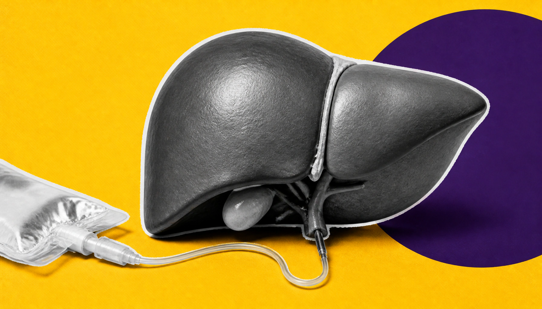 Hepatic arterial infusion chemo shows promise for hard-to-treat colorectal cancer