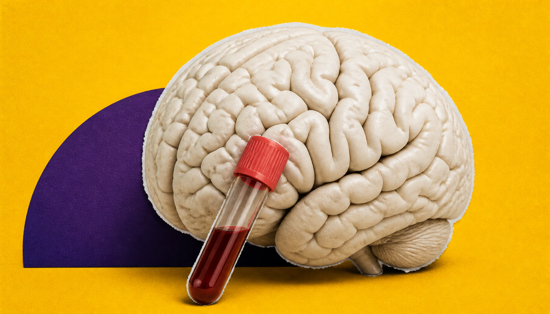Alzheimer's research is entering its precision medicine era