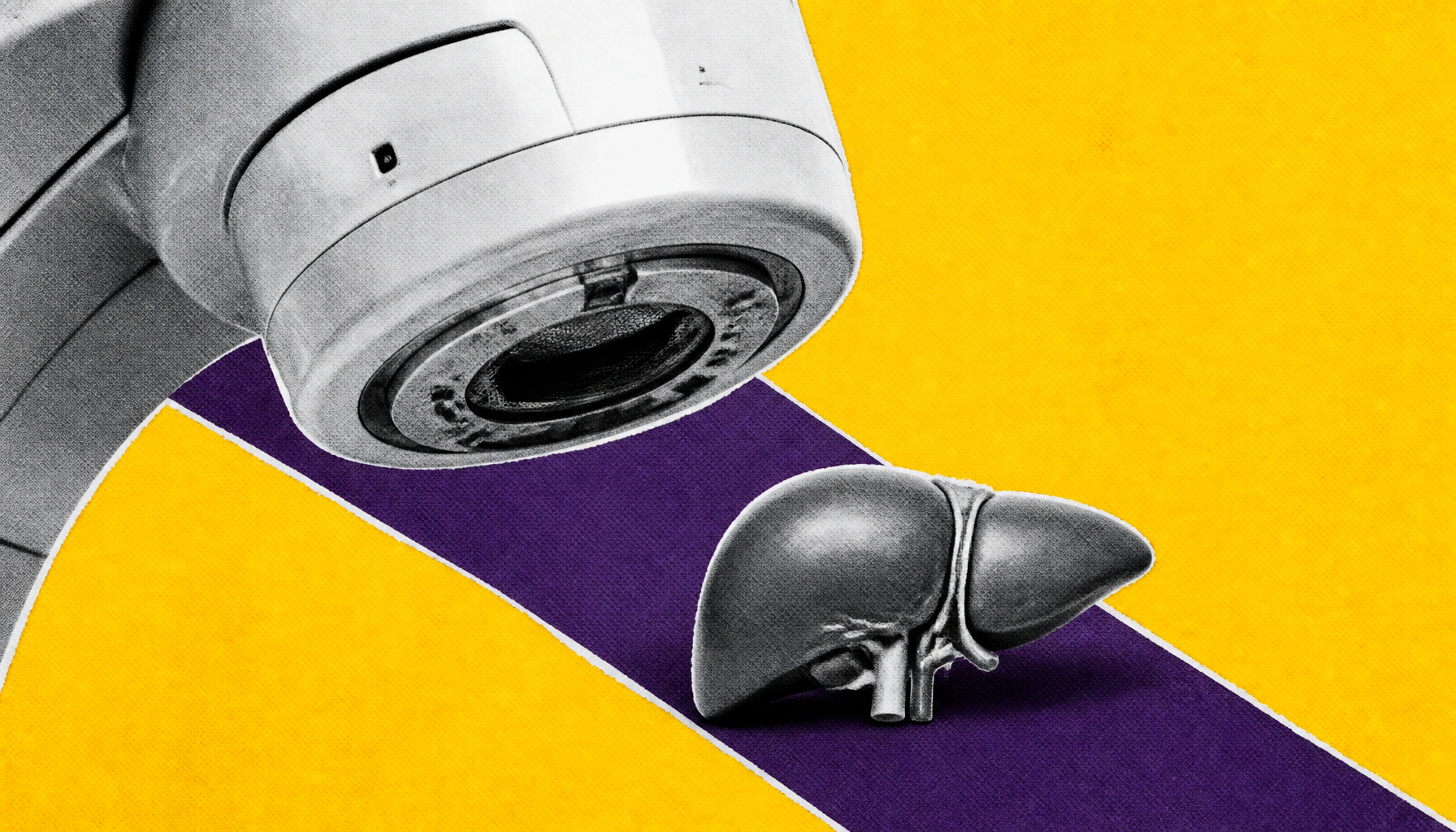External beam radiation matches survival benchmarks for early-stage liver cancer