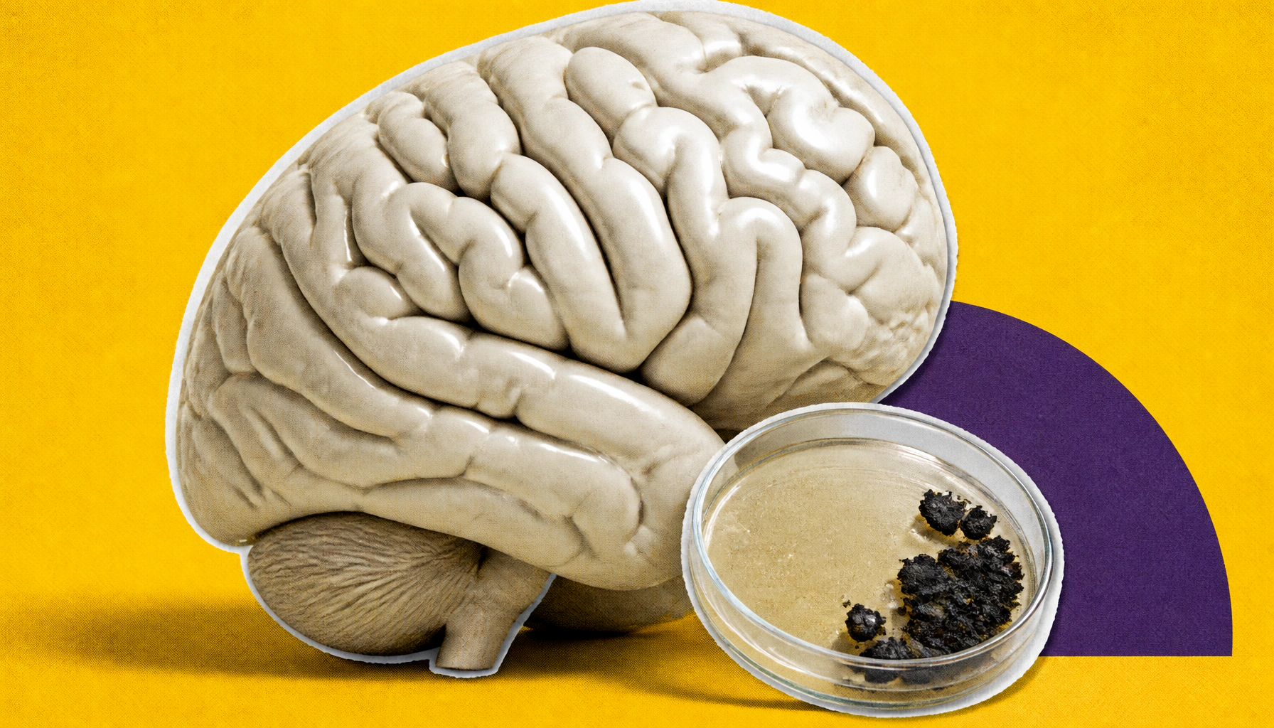 Aging protein EPS8 may be the missing link between getting older and brain diseases like ALS and Huntington's