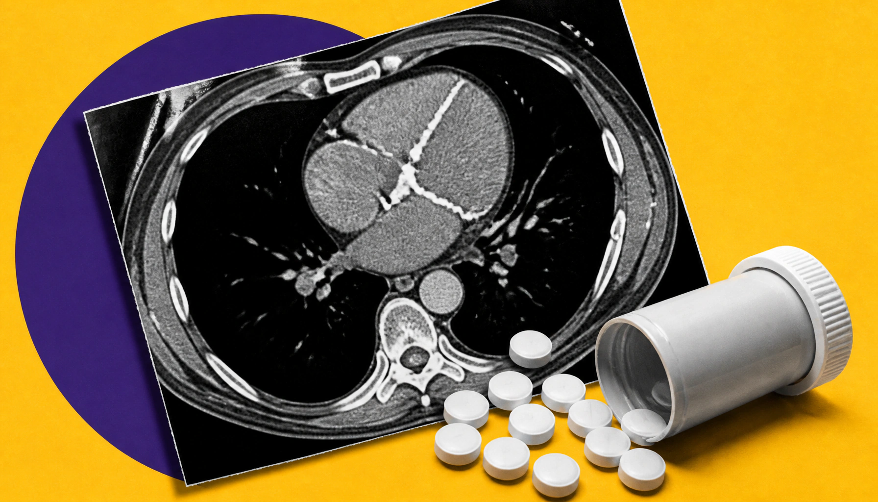 Routine CT scans could flag hidden heart risk in psoriasis patients