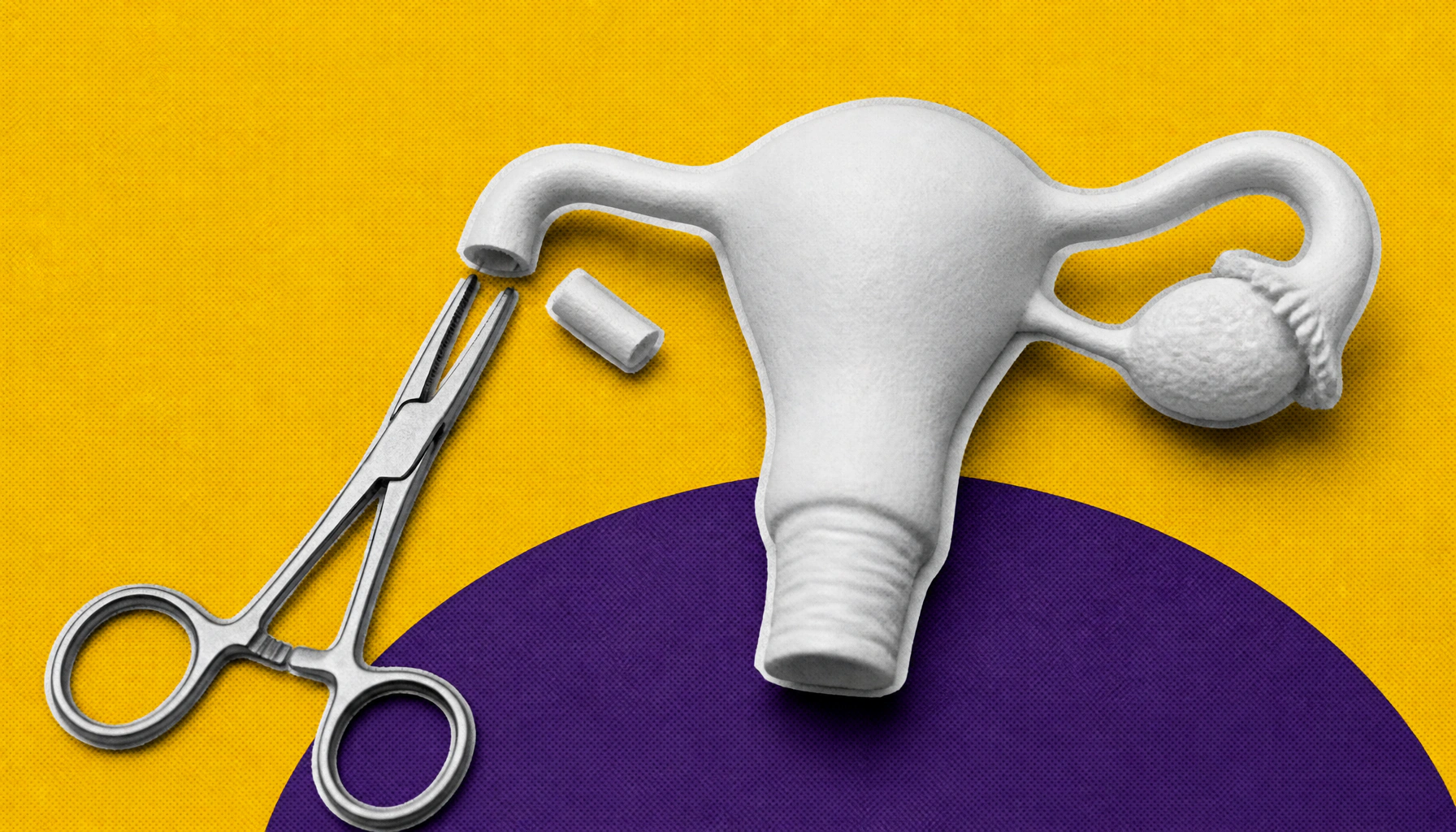 A less aggressive ovarian cancer prevention surgery offers better quality of life for high-risk women