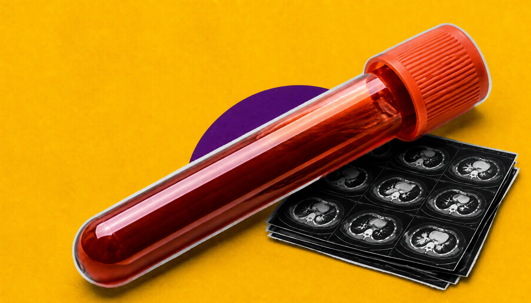 UK clinic rolls out Galleri blood test to screen for 50+ cancers at once