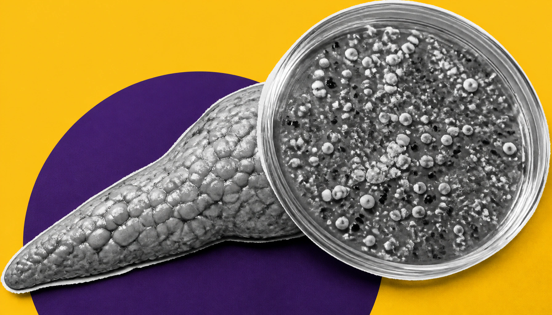 Probiotic bacteria engineered to fight pancreatic cancer from the inside out