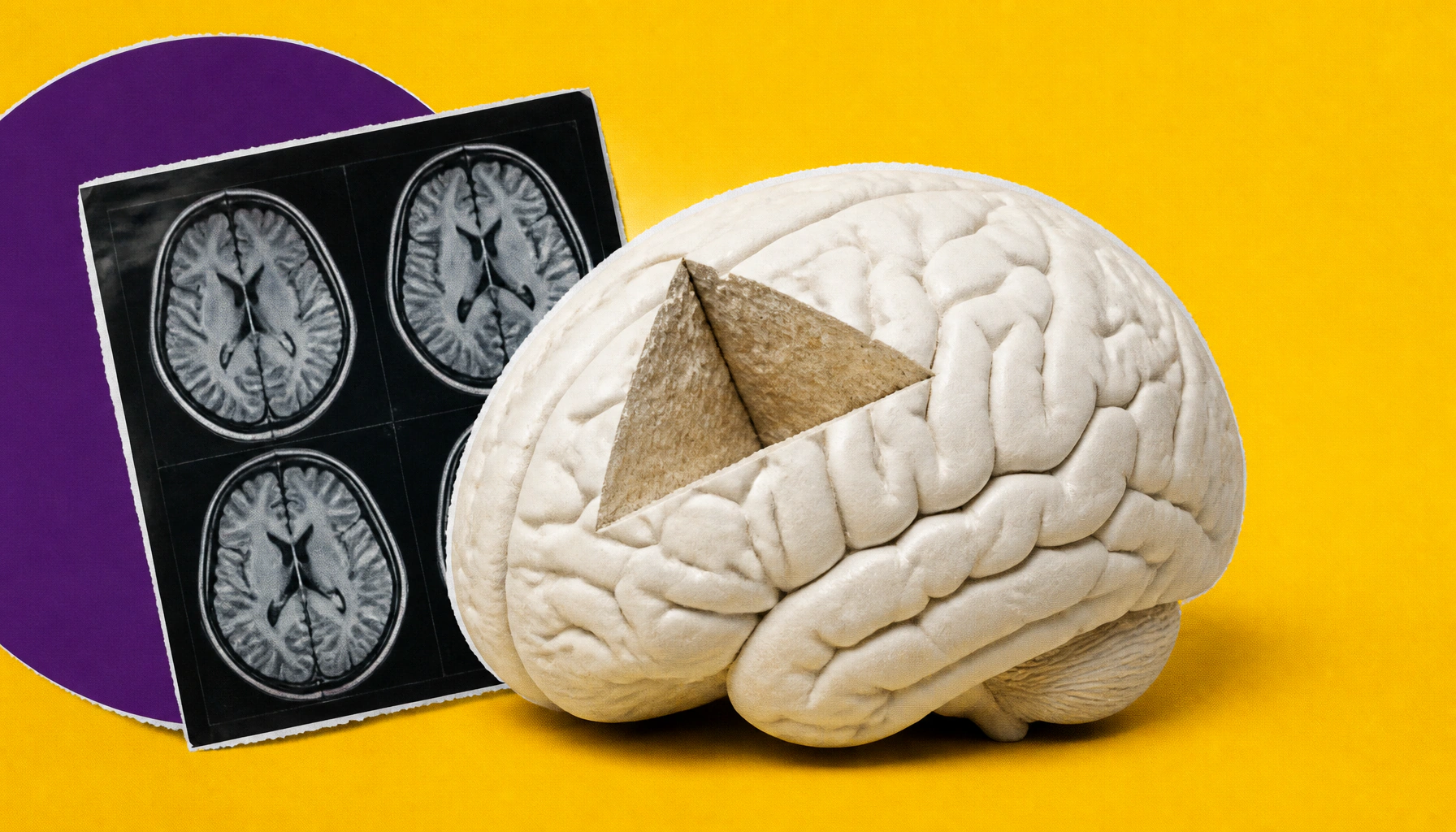 Schizophrenia's synaptic loss follows a surprisingly organized brain pattern