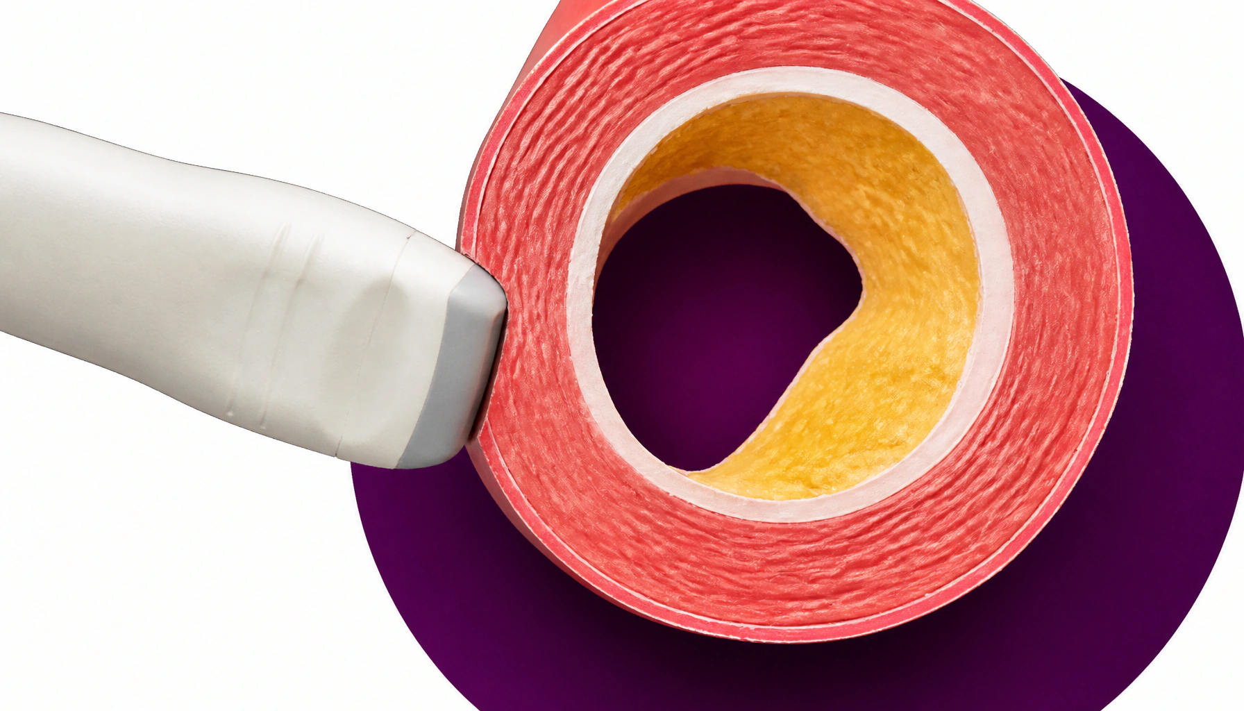Silent atherosclerosis is hiding in more than half of "healthy" adults
