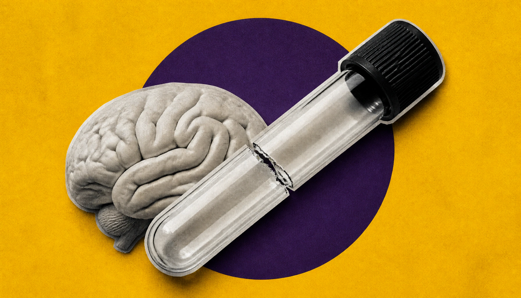 Alzheimer's biomarker p-tau217 falls short for detecting cognitive decline in Parkinson's patients