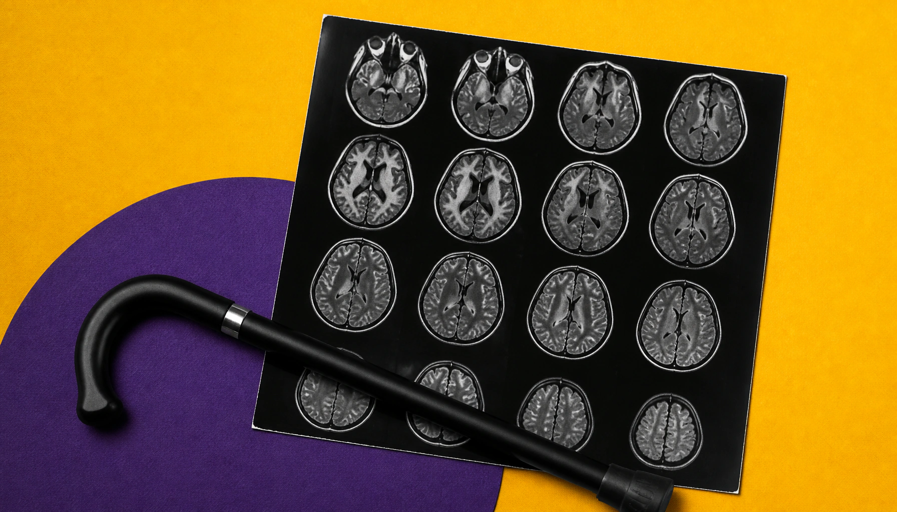 MRI brain scans may predict when early-onset Alzheimer's patients lose independence