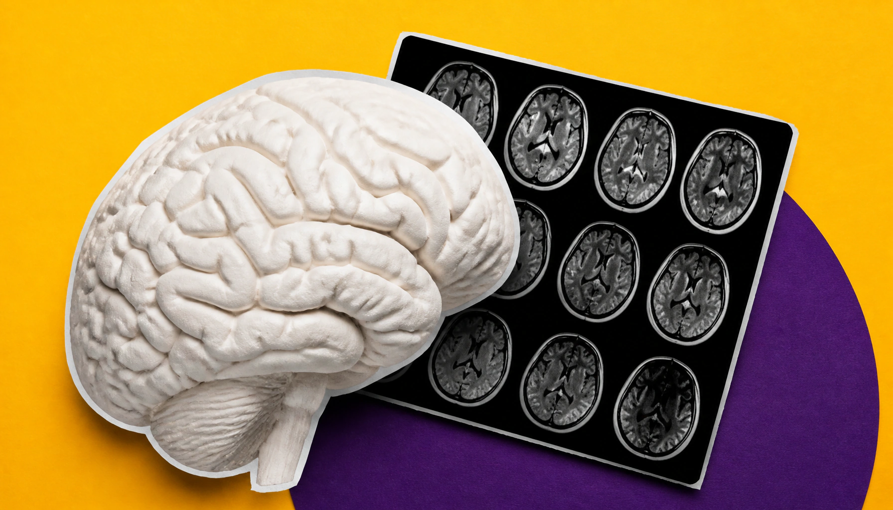Brain shows Alzheimer's signs 7+ years before plaques are detectable