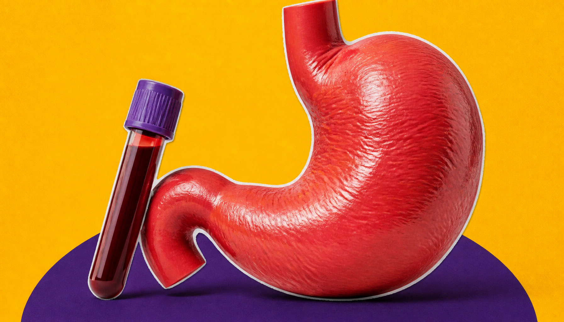 Anemia and autoimmune gastritis: what's driving the connection?