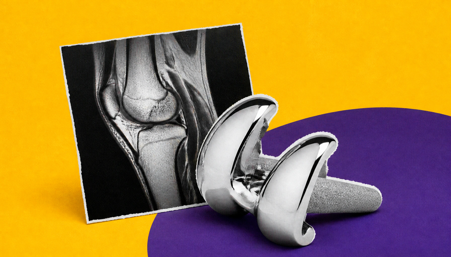 AI matches human experts in predicting knee replacement via MRI cartilage analysis