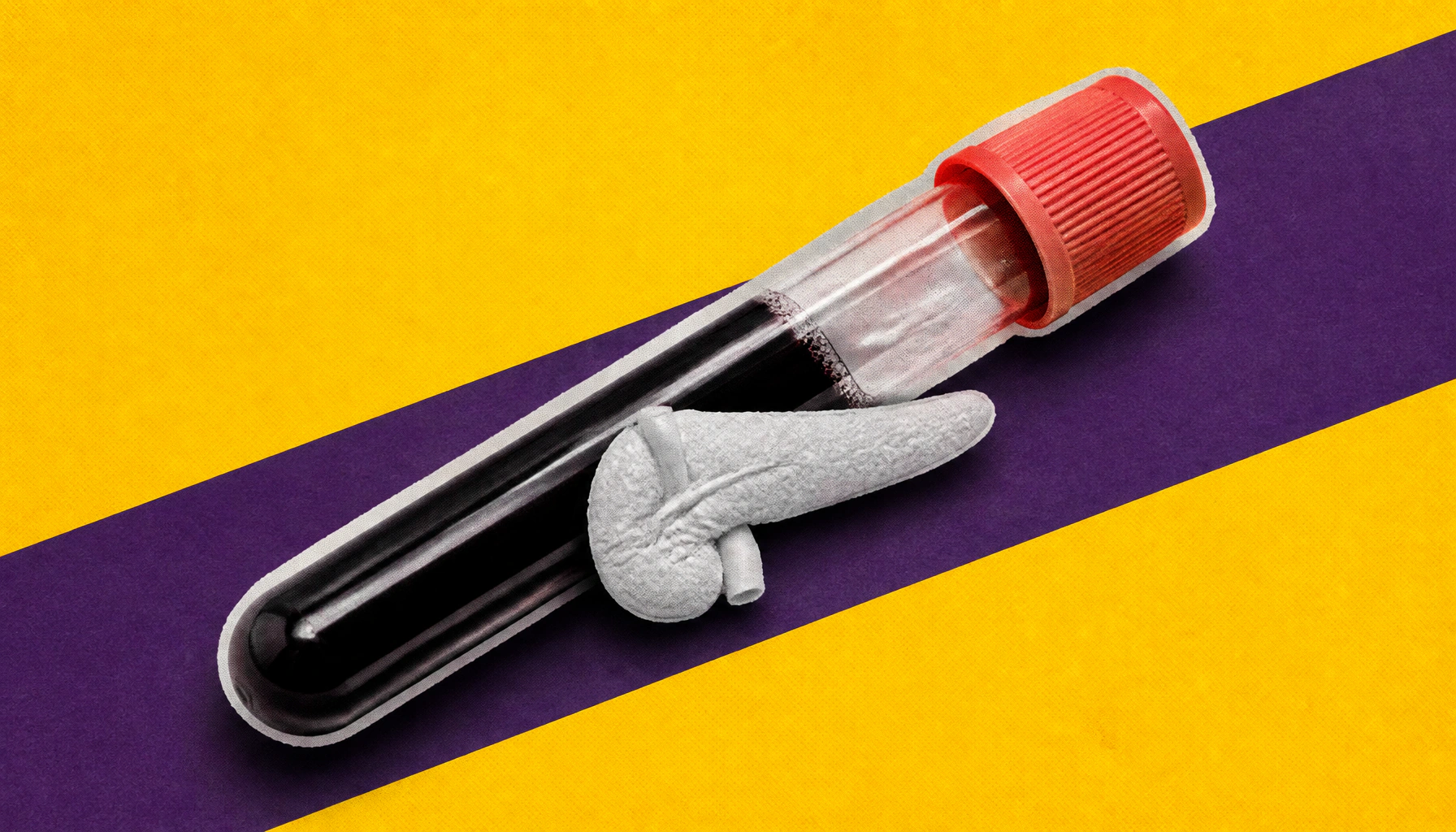 New blood tests are changing the game for early pancreatic cancer detection