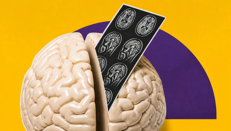 MRI brain age gap could flag who's heading toward dementia