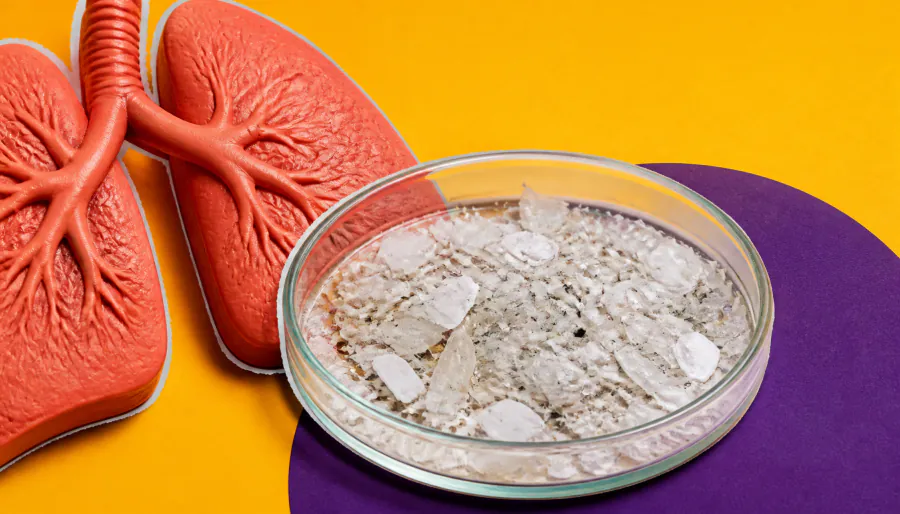 Microplastics found more often in the lungs of patients with lung cancer