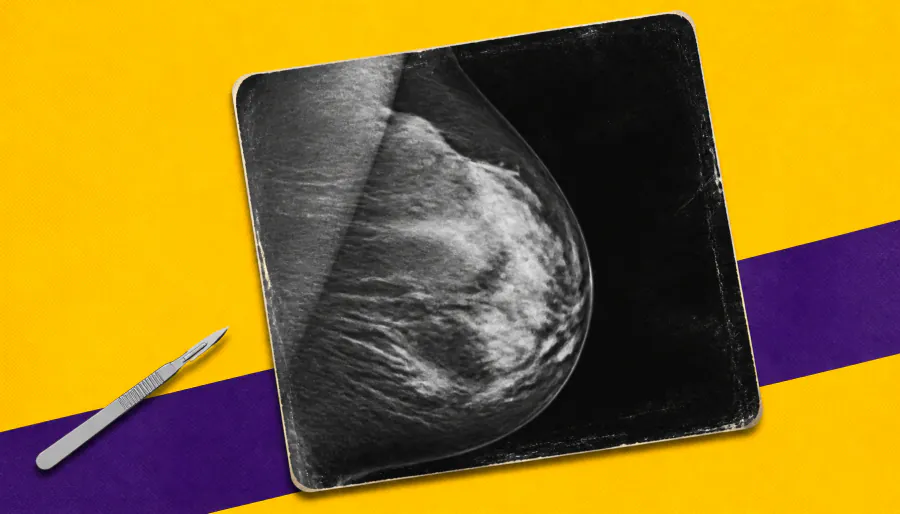 Breast cancer screening overdiagnosis may be far lower than we thought
