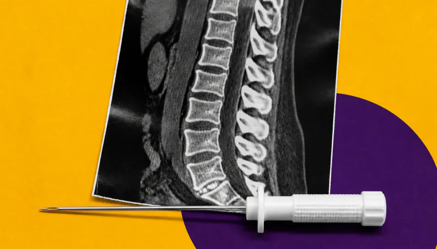 Incidental vertebral fractures on CT scans linked to higher myeloma risk — but don't panic yet
