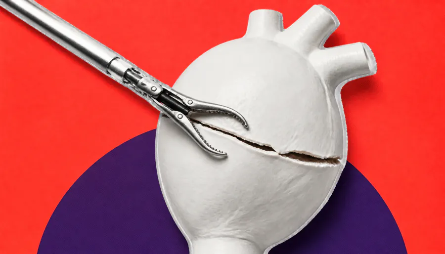 Retzius-sparing prostate surgery linked to worse long-term cancer control