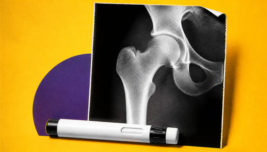 Don't wait until 65: Osteoporosis screening and treatment should start at perimenopause