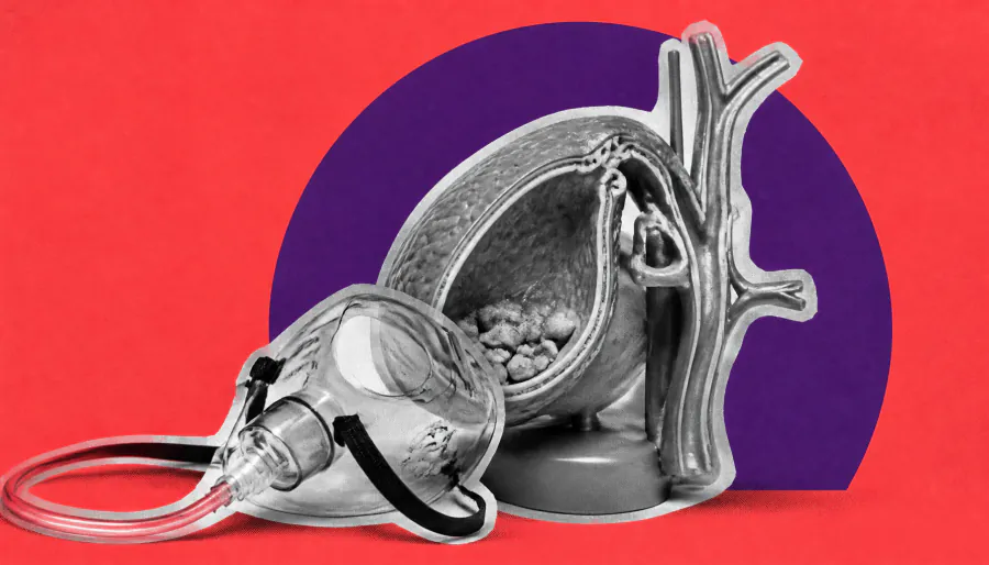 Timing of gallbladder removal after pancreatitis matters — and sex plays a bigger role than you'd think