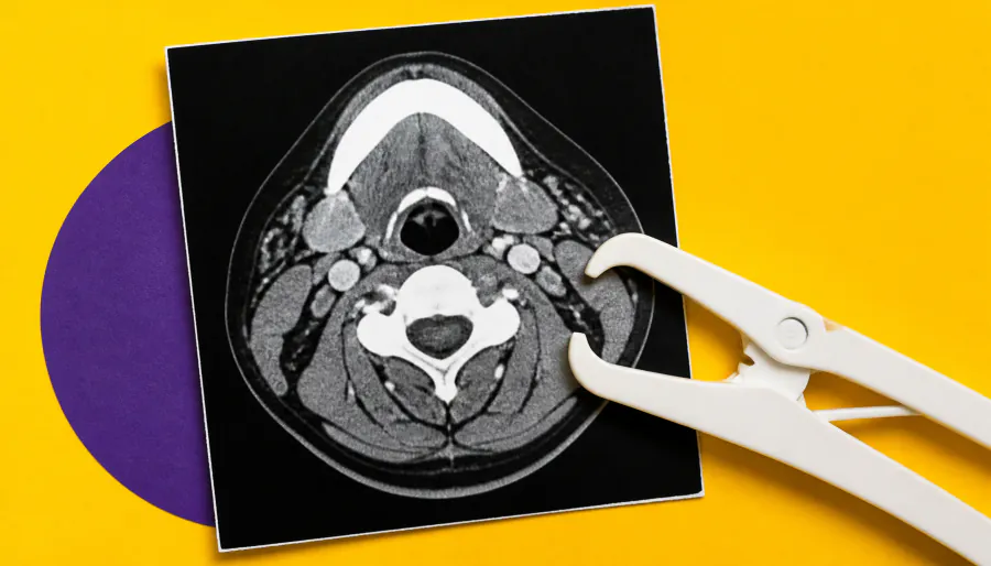 Muscle mass on CT scans predicts survival in head and neck cancer patients receiving radiation