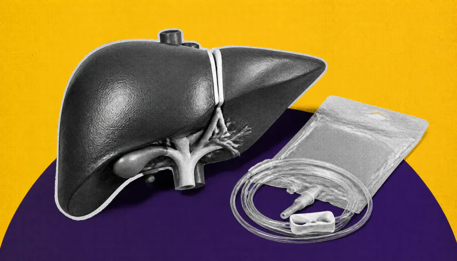 Liver transplants show promise for select colorectal cancer patients