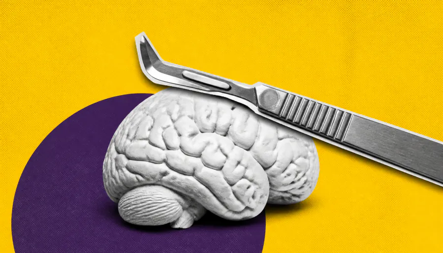 Incisionless brain surgery shows real promise for treatment-resistant depression