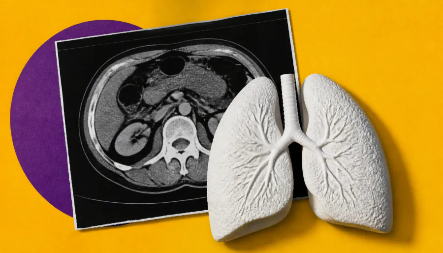 It's not your weight — it's where the fat is: central obesity linked to lung cancer risk