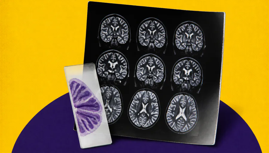 Diffusion MRI may offer a window into frontotemporal dementia's hidden pathology