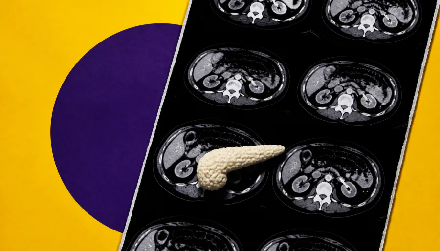 Routine CT scans could flag pancreatic cancer years before diagnosis