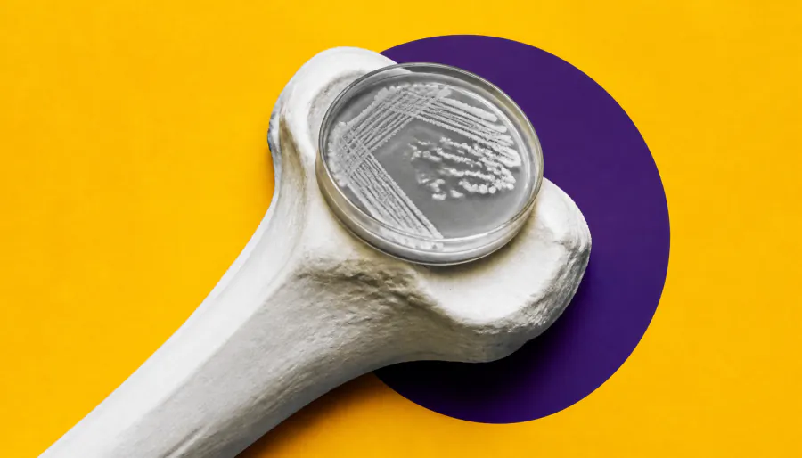 Rare Salmonella bone infection in a healthy teen — a case that defies expectations