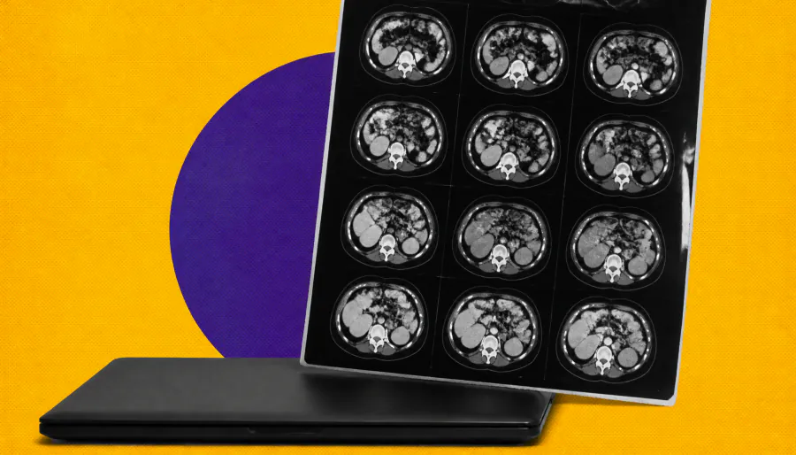 AI tool spots pancreatic cancer over a year before diagnosis — and outperforms radiologists