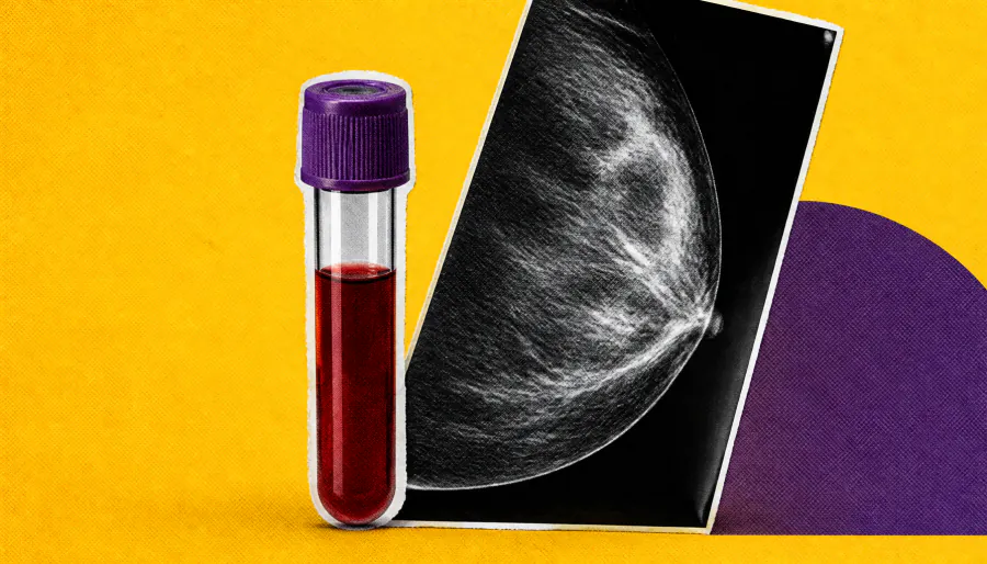 A simple blood test could catch breast cancer earlier than mammograms alone