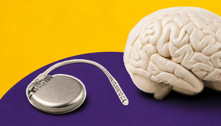 Vagus nerve stimulation delivers lasting seizure relief for drug-resistant epilepsy patients