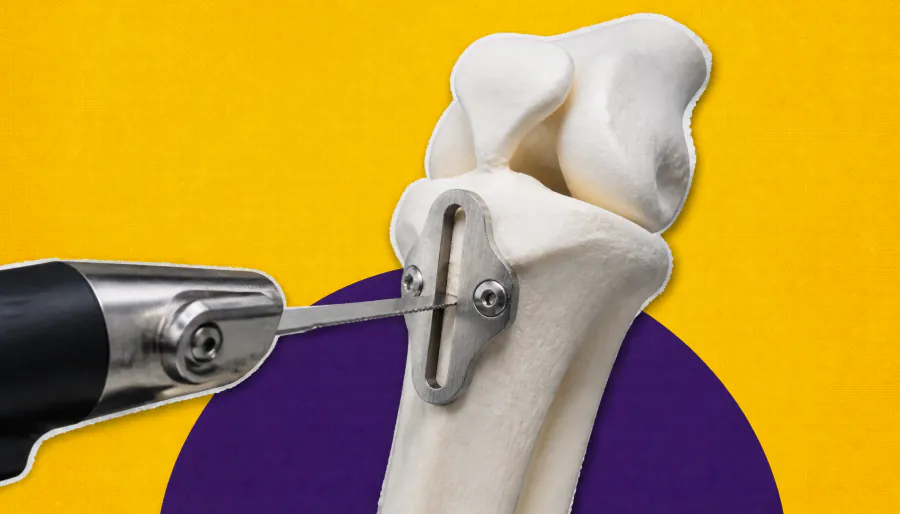 3D imaging and custom guides are transforming kneecap surgery
