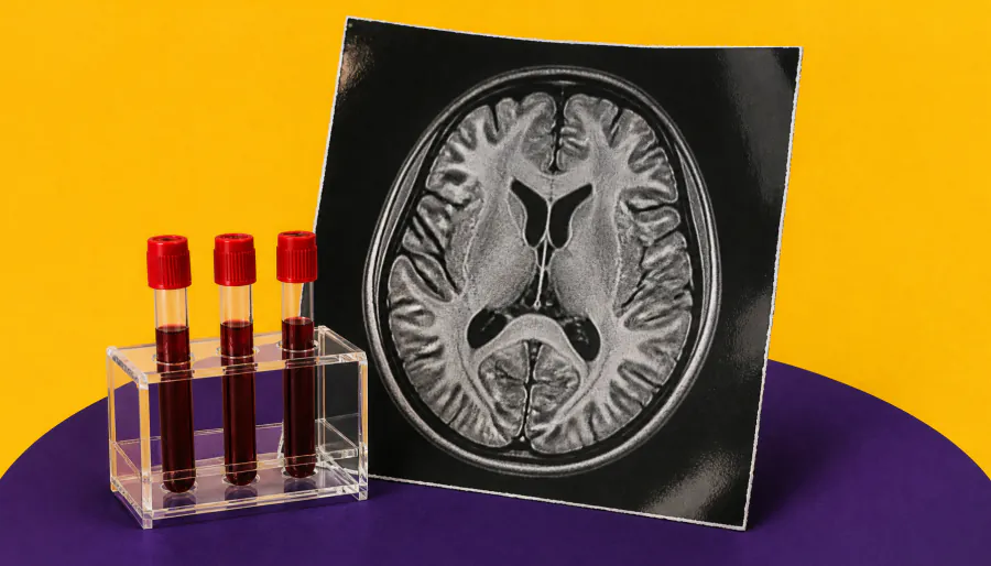 AI can detect MS and NMOSD years before diagnosis — here's what it's finding